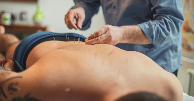 Acupuncture